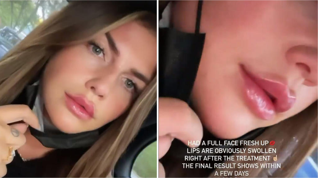 Farina Opoku zeigt ihr Gesicht direkt nach dem Beauty-Eingriff.