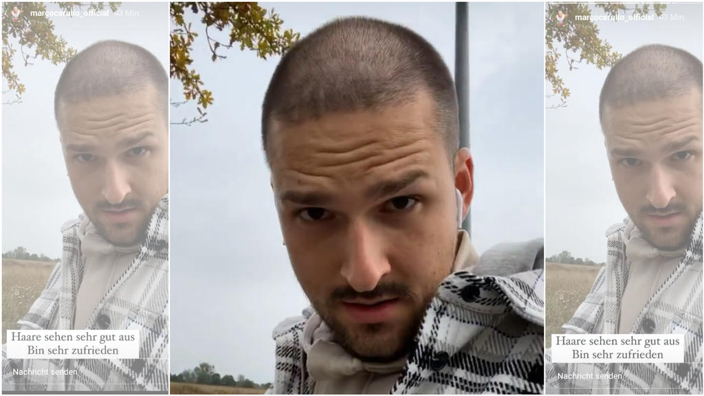 Marco Cerullo zwei Wochen nach der Haartransplantation