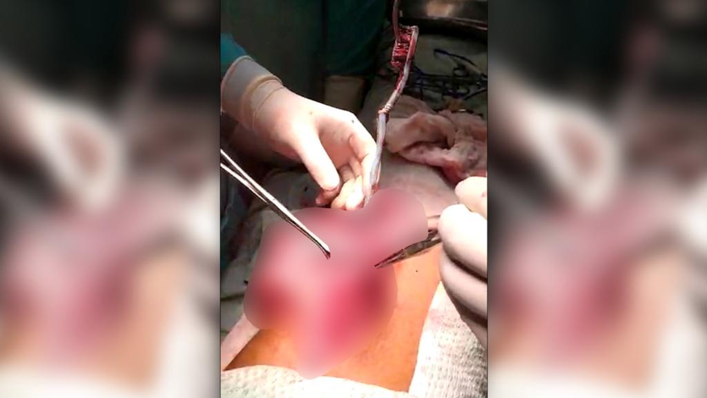 Ärzte entfernen eine Zahnbürste aus dem Magen des indischen Jungen.