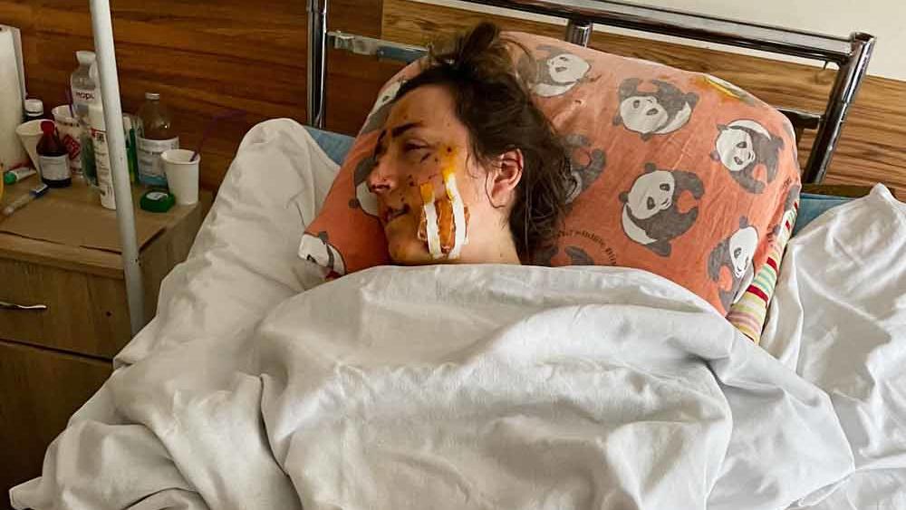 Lidiia kam erst 7 Stunden nach der Explosion ins Krankenhaus