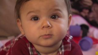 Die 9 Monate alte Chiara aus Braunschweig hat eine seltene Fehlbildung. So selten, dass nur ein Neugeborenes unter einer Million Kinder darunter leidet.