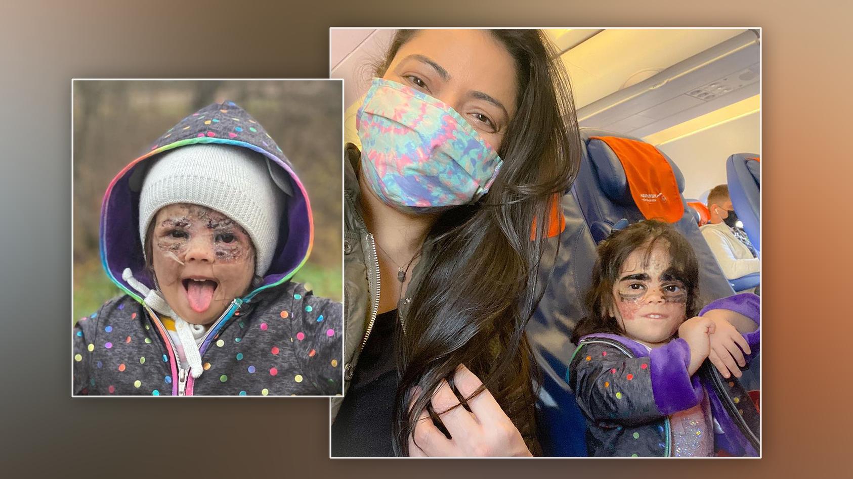 Die zweijährige Luna aus Florida ist ihre "Batman"-Maske schon fast los! Gemeinsam mit ihrer Mutter Carol Fenner fliegt sie regelmäßig nach Russland, um sich dort Behandlungen zu unterziehen.