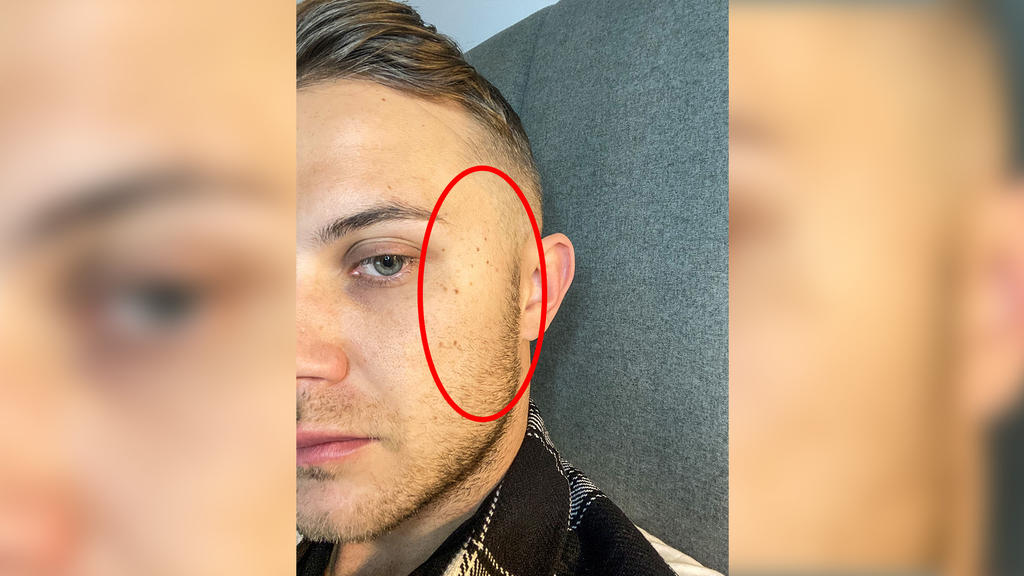 Dylan zeigt seine Muttermale