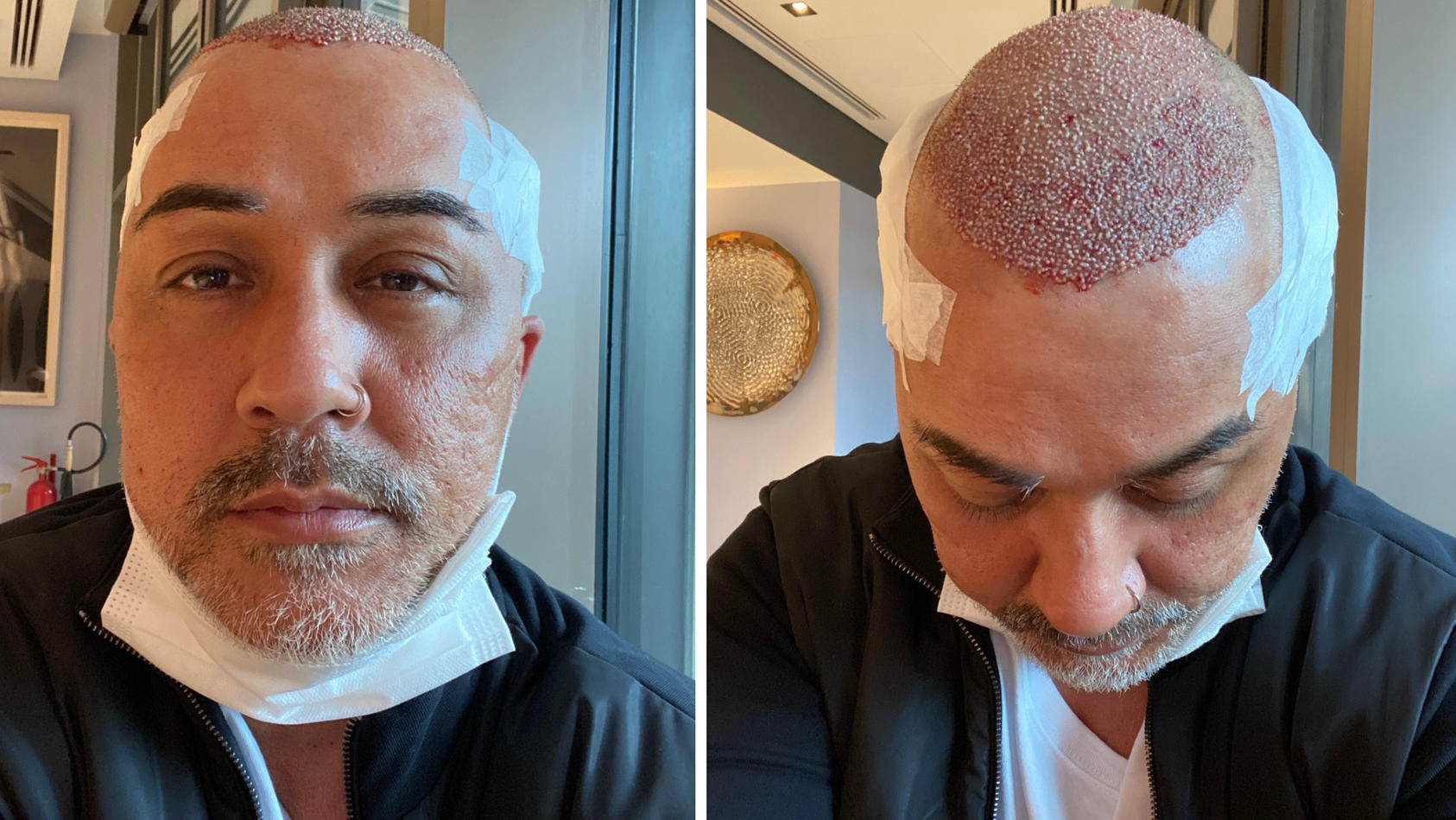 Mike Leon Grosch hat sich einer Haartransplantation unterzogen.