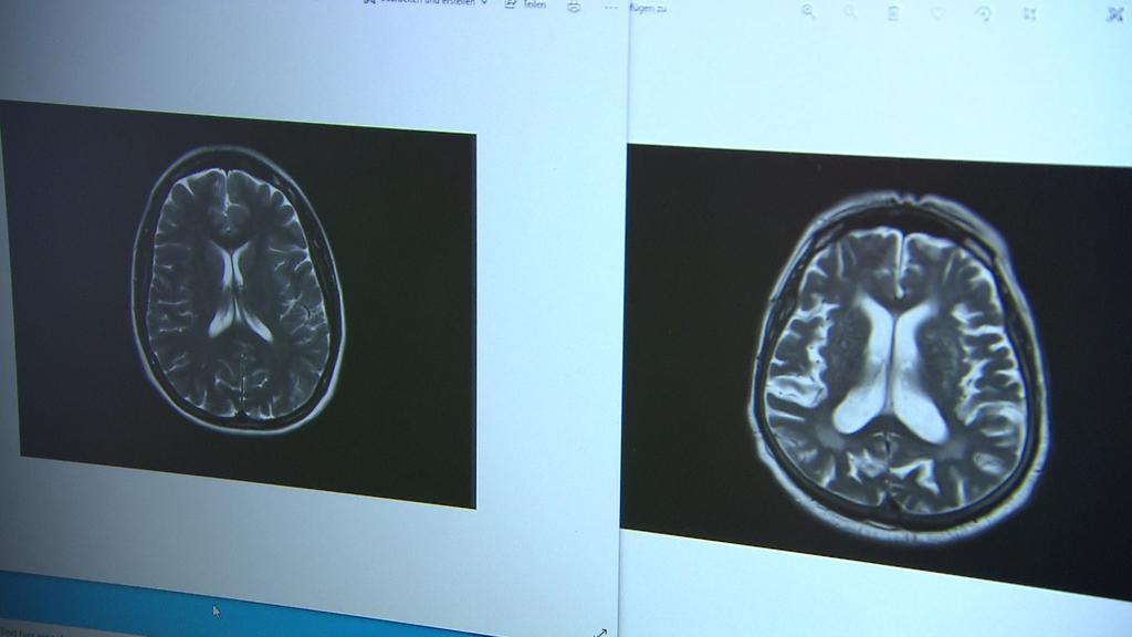 Röntgenaufnahmen von zwei Gehirnen