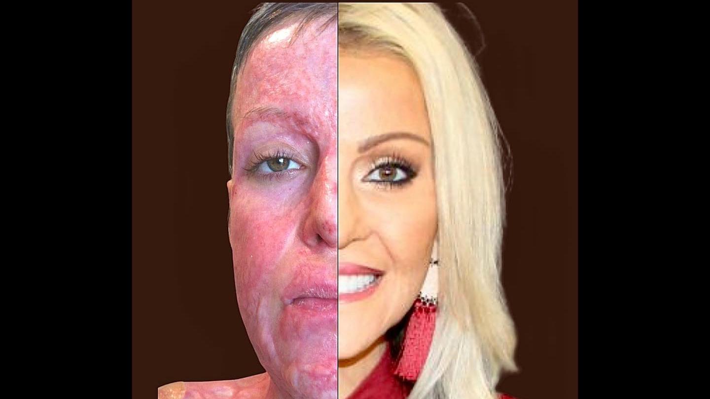 Dana Vulin Wurde Brand Opfer Einer Eifersüchtigen Ehefrau Jetzt Zeigt Sie Stolz Ihre Transformation 