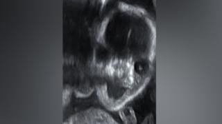 Gruseliges Ultraschall-Foto zeigt "Dämon"