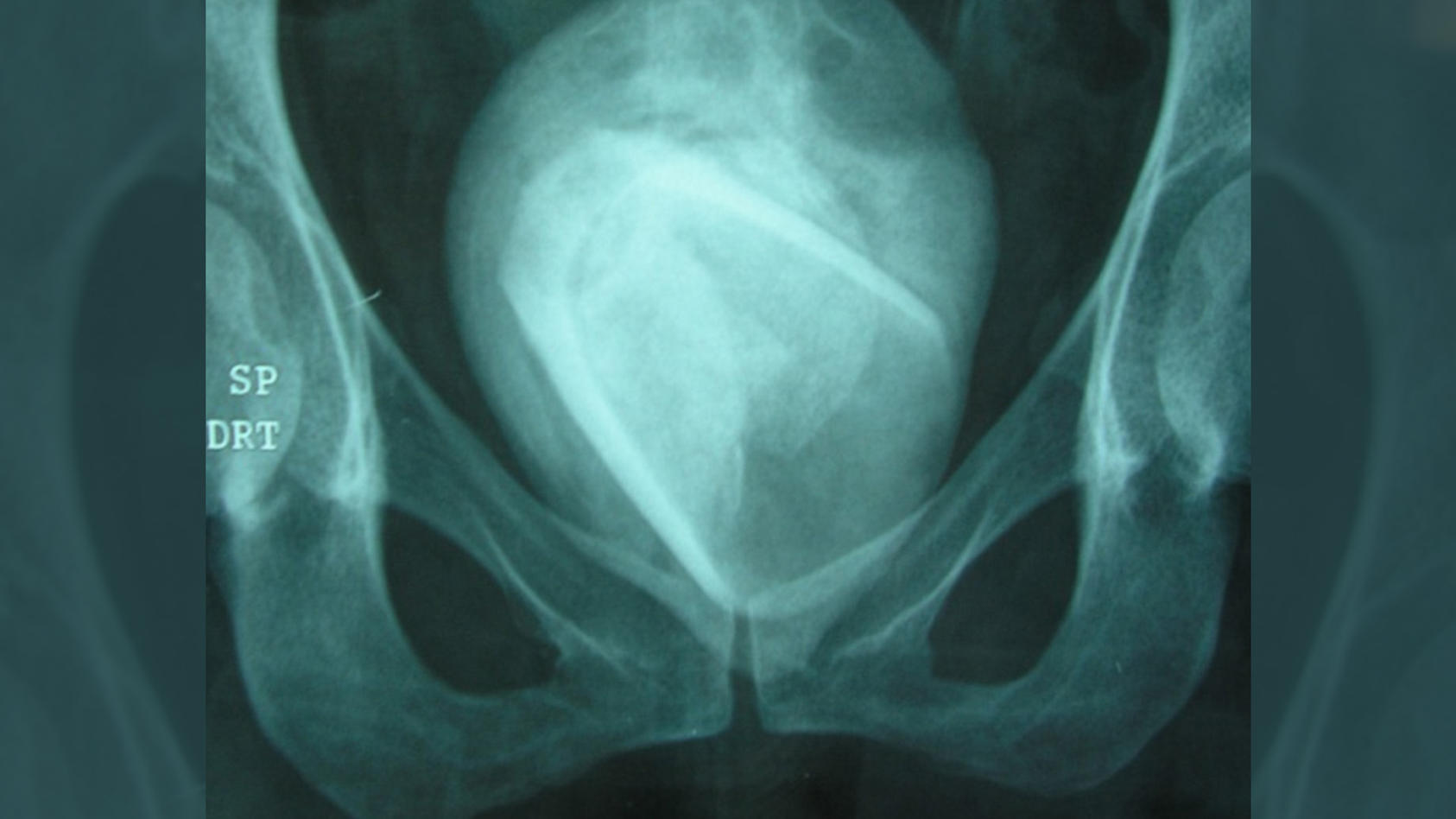 Ein Röntgenbild zeigt einen Fremdkörper in der Form eines Trinkglases, das von einem Blasenstein umhüllt ist