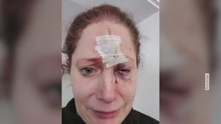 Nicole Kilians linke Gesichtshälfte ist nach einem Hundeangriff schwer verletzt.