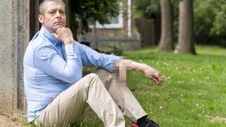 Malcolm MacDonald, 47, war am Boden zerstört, als sein Penis nach einer Horrorinfektion im Jahr 2014 abfiel. Ärzte züchteten einen Ersatz auf seinem linken Arm.