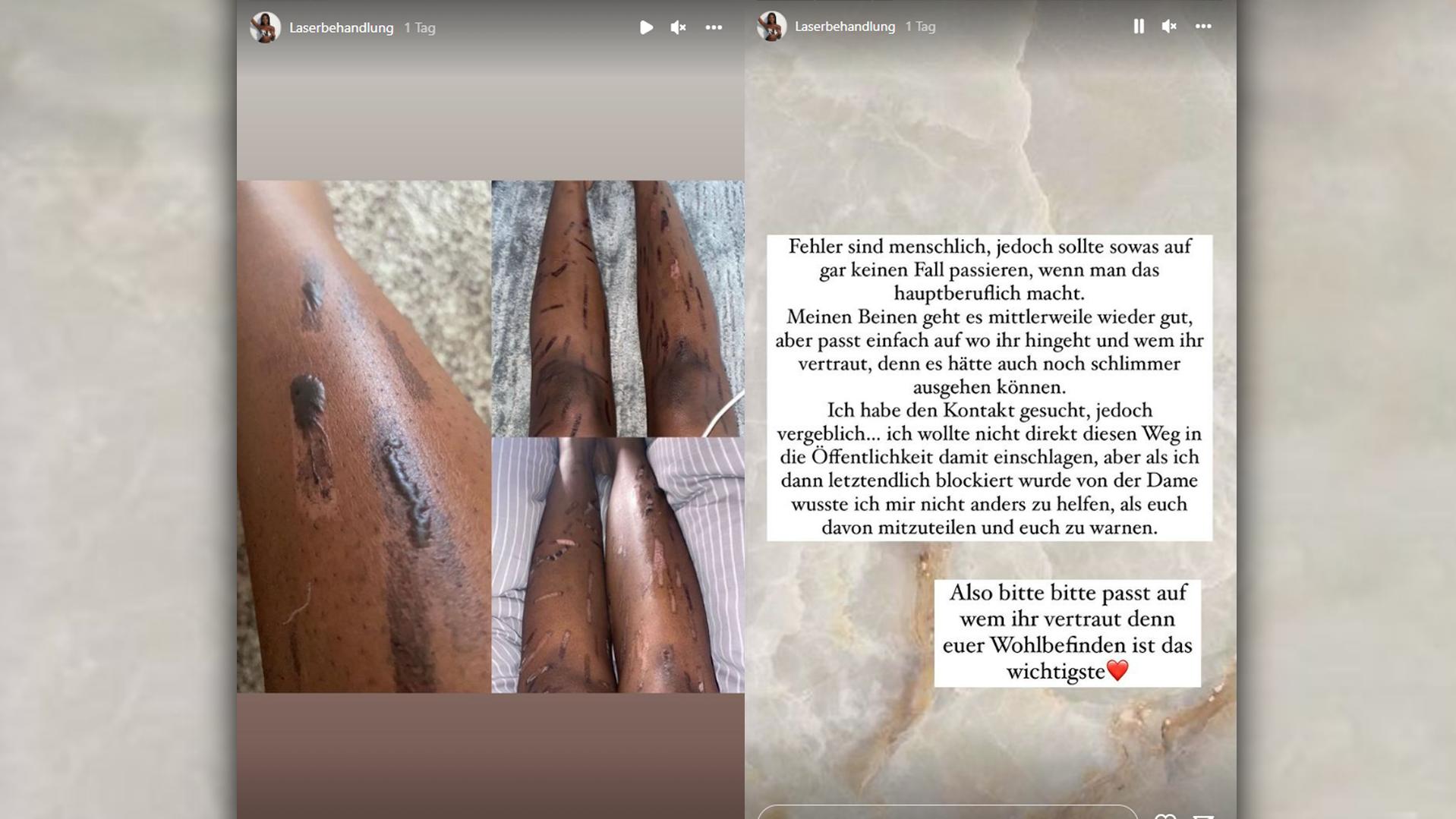 Jasmin Sainabou Jägers zeigt bei Instagram die Folgen der Laserbehandlung