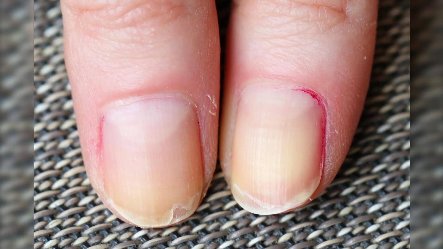 gelbe-nagel-durch-nagellack-diese-hausmittel-helfen-wirklich