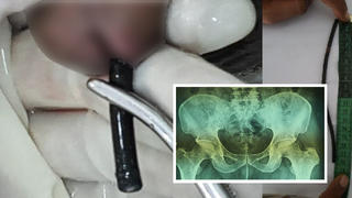 Ärzte ziehen Mann 18-Zentimeter-Kabel aus Penis.