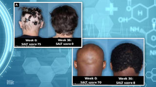 Betroffene mit kreisrundem Haarausfall, die im Rahmen einer neuen Studie ein neues Medikament getestet haben.