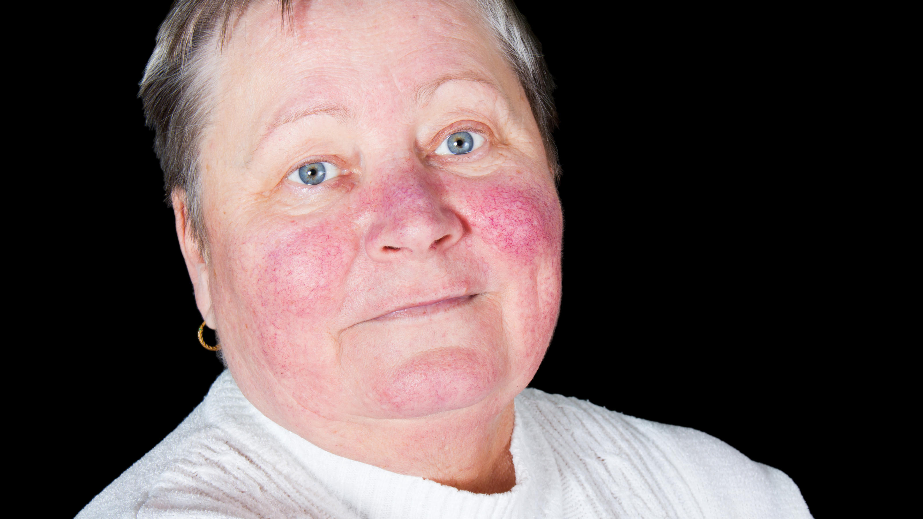 Eine ältere Frau mit der Hautkrankheit Rosazea.