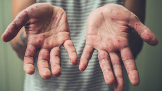 Hautausschlag an den Händen ist eines typischen Symptome der Hand-Fuß-Mund-Krankheit