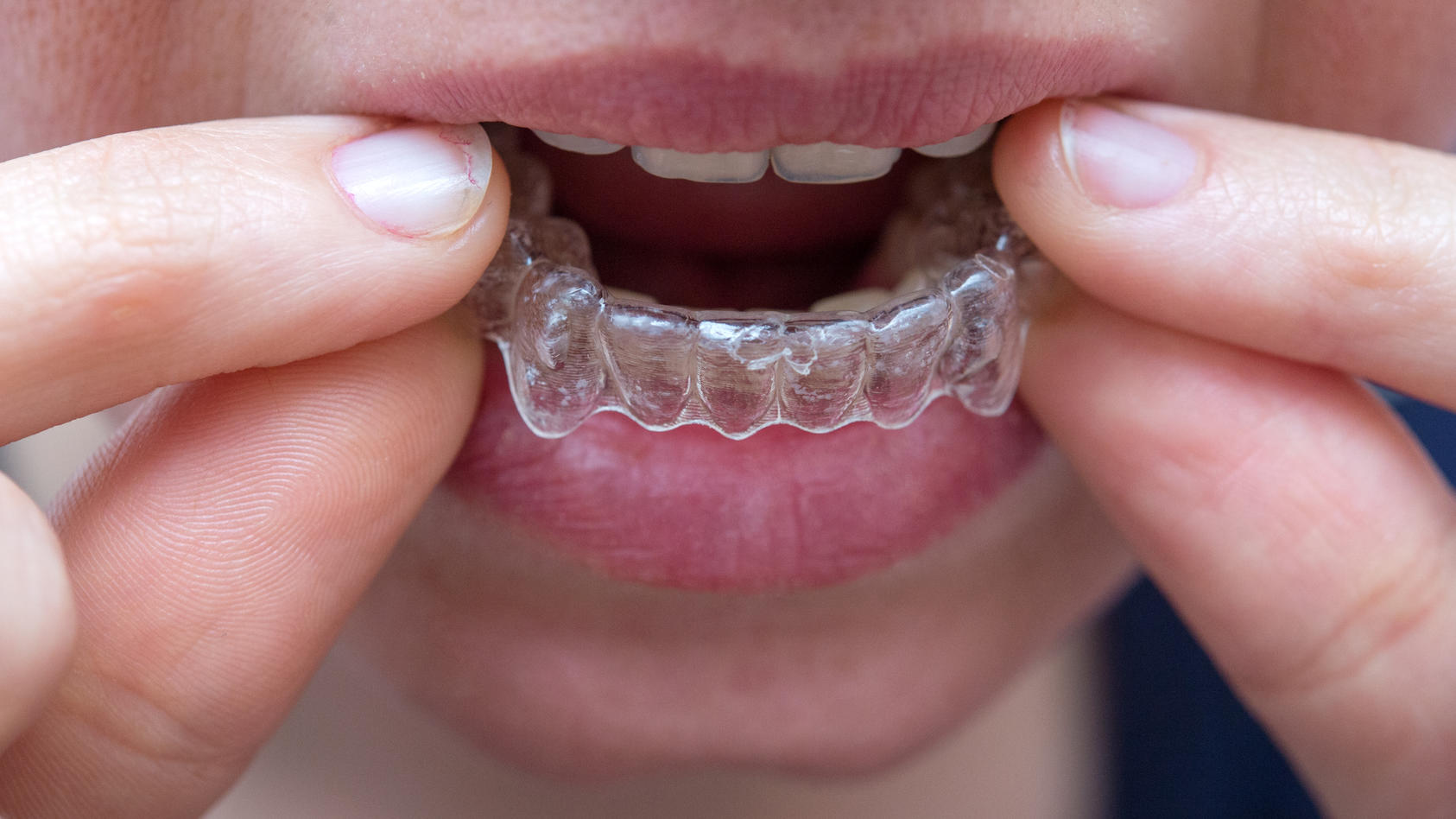 RTL-Reporterin wagt den Test - Wie gefährlich sind die Zahnschienen von DrSmile?