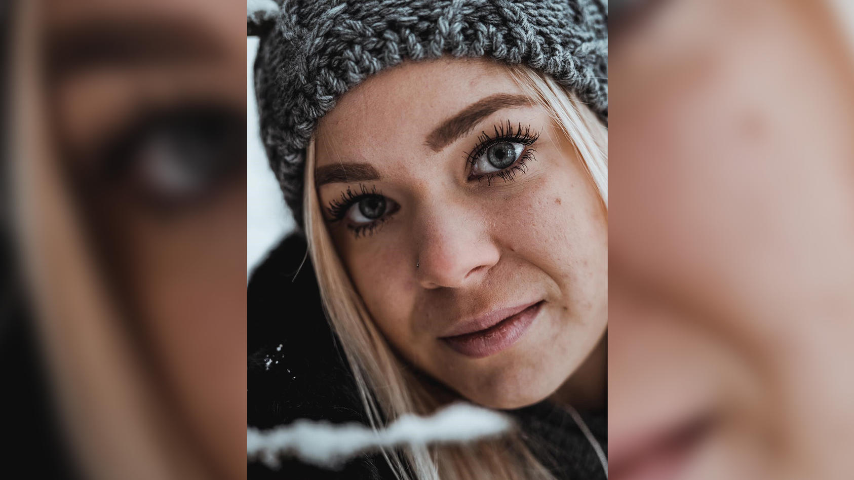 Vanessa, 25 anni, soffre della sindrome della neve