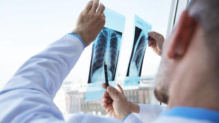 Ärzte schauen sich eine Röntgenaufnahme eines Brustkrobs an