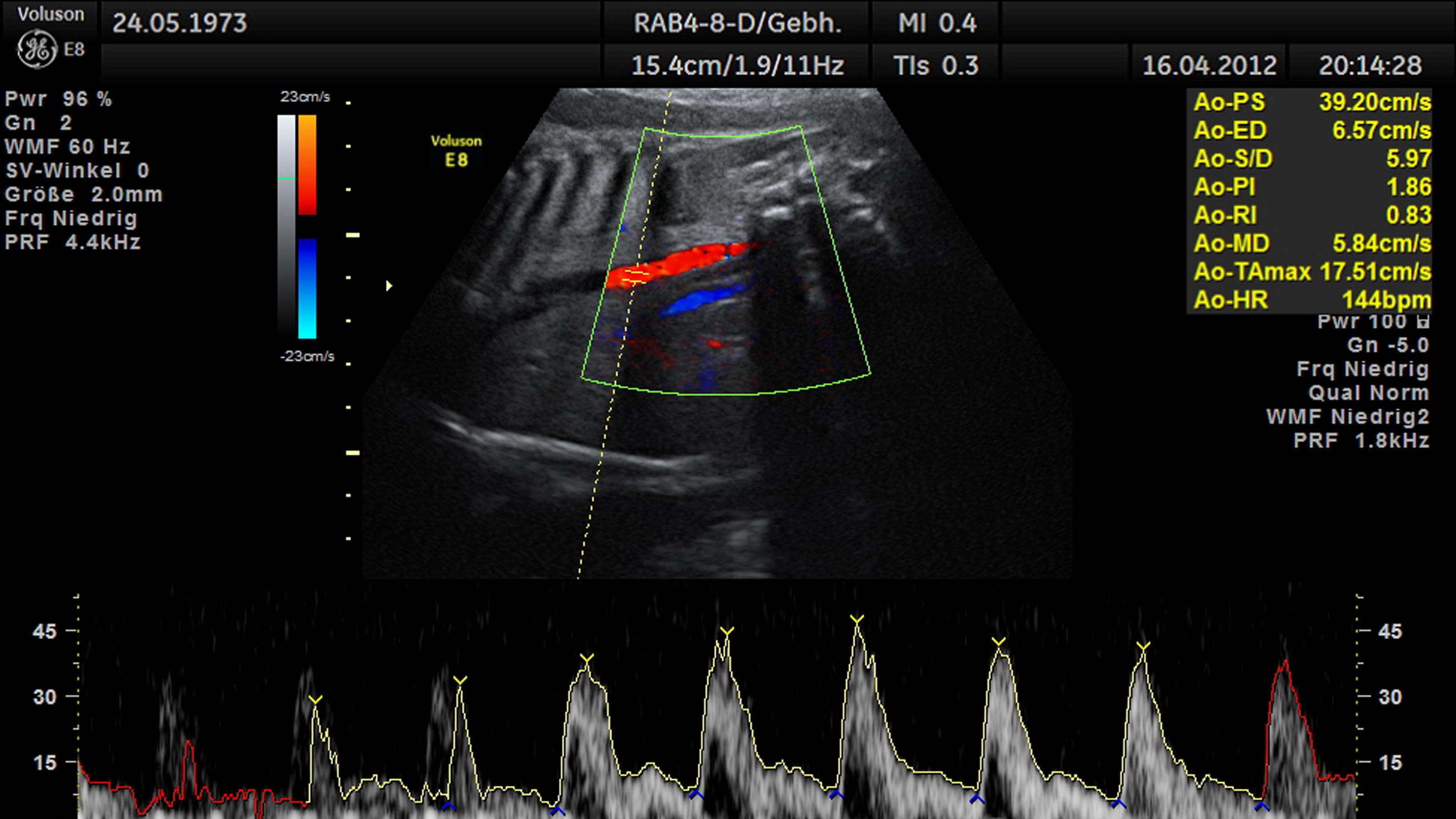 Ultraschallaufnahme eines Embryos im Mutterleib mit Herztondiagramm | sonogram of an embryo in the womb with heart tone diagram
