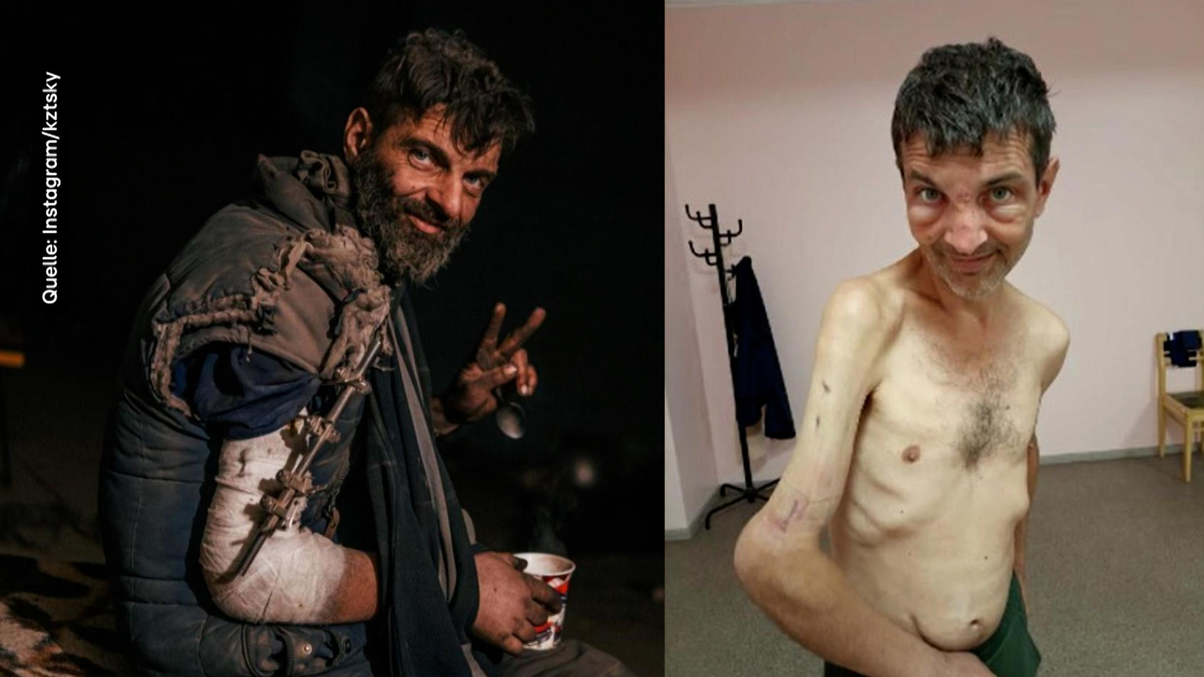 das-bild-des-vollig-abgemagerten-und-von-einer-schlimmen-armverletzung-gezeichneten-ukrainischen-kriegsgefangenen-michailo-dianow-ging-ende-september-um-die-welt