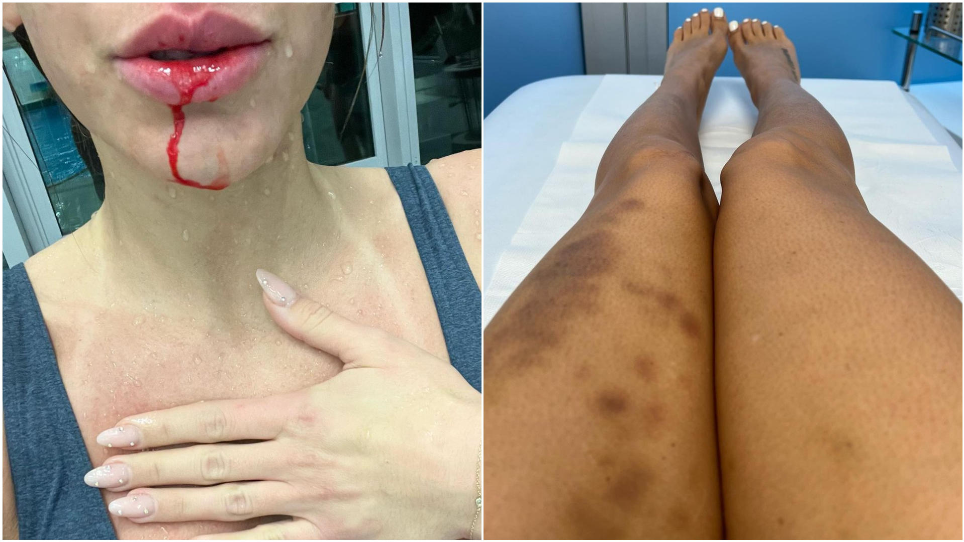 Autsch! Vanessa Mariposa teilt auf ihrem Instagram-Kanal Fotos von Verletzungen, die sie sich beim Training fürs "RTL Turmspringen" zugezogen hat. Quelle: instagram/vanessa_mariposa