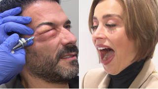 Marc Terenzi lässt sich Kohlendioxid ins Augenlid spritzen - seiner Verlobten Verena Kerth gefällt nicht was sie sieht