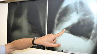 ARCHIV - 17.06.2010, Bayern, München: Der Leiter der Pneumologie (Lungenheilkunde) im Klinikum der Universität München zeigt auf ein Röntgenbild einer von Krebs befallenen Lunge. (zu dpa "Schätzung für Deutschland: Gut 240 000 Menschen sterben 2023 an Krebs") Foto: Felix Hörhager/dpa +++ dpa-Bildfunk +++