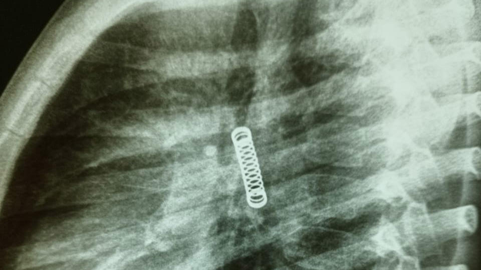 Fünfjähriger Junge aus Paraguay verschluckt eine Metallfeder und hat sie drei Monate in seiner Lunge