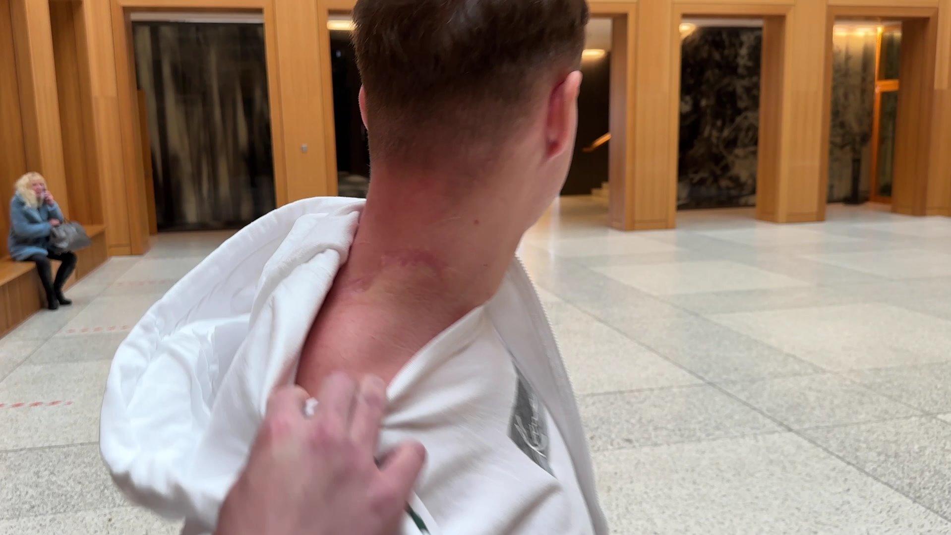 Adrian zeigt seine schlimmen Narben.