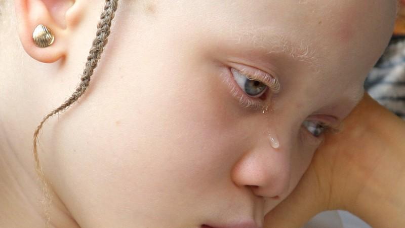 Dieses Mädchen leidet unter Albinismus, einer der häufigsten Erbkrankheiten.