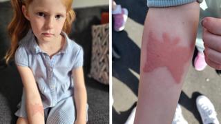 Matilda (7) hat allergische Reaktion auf Henna-Tattoo. Mutter Kirsty Newton warnt nun.