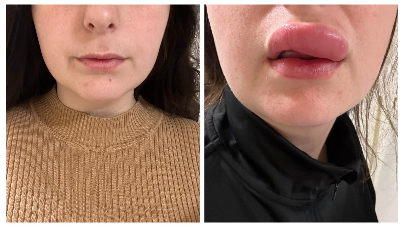 ellie-gallear-22-vor-ihrer-lippenfiller-behandlung-links-und-danach-rechts