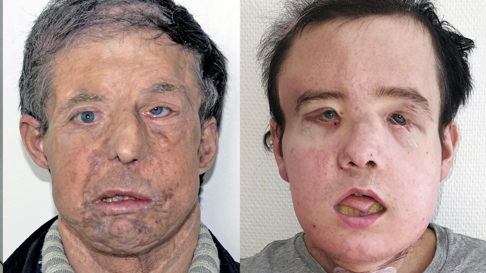 Drei Bilder eines transplantierten Gesichts.