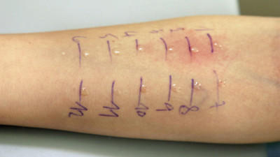 Ein Allergietest (Prick-Test) auf dem Unterarm eines zehnjährigen Mädchens in einer Arztpraxis 