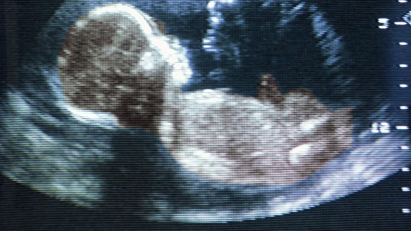 Nackenfaltenmessung beim Ungeborenen