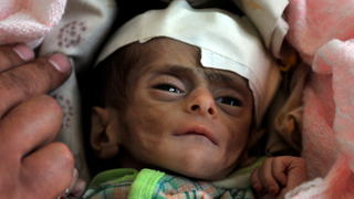 (Sperrfrist 15. April 18.30 Uhr)FILE - epa03373753 A doctor checks a three-month old severely malnourished child at a therapeutic feeding center in Sana'a, Yemen, 29 August 2012. Nearly a million children in Yemen are suffering from acute malnutrition, according to aid groups. EPA/YAHYA ARHAB (zu dpa:"165 Millionen Kinder weltweit leiden an Unterernährung" vom 15.04.2013) +++(c) dpa - Bildfunk+++