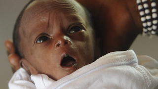 (Sperrfrist bis 06.06.2013, 0101 Uhr) ARCHIV - Ein unterernährtes Kind liegt am 05.07.2012 in einer Ernährungsstation in einem Hospital in Kaya, Burkina Faso. Einer neuen Studie zufolge sterben jährlich rund 3,1 Millionen Menschen aufgrund von Mangelernährung. Foto: Helmut Fohringer/dpa (zu dpa-Zusammenfassung: «Mangelernährung ist Grund für fast die Hälfte aller Kindstode» vom 05.06.2013) +++(c) dpa - Bildfunk+++