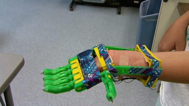 Hand-Prothese aus dem 3D-Drucker