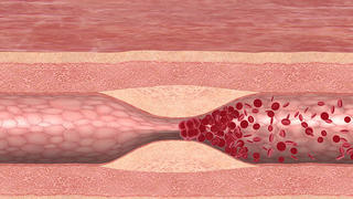 Das Bild zeigt ein Blutgerinnsel, das sich durch eine Engstelle in der Arterie gebildet hat. Der gestaute Blutstrom bildet einen Thrombus, der zum GefÃ¤ÃŸverschluss fÃ¼hrt.