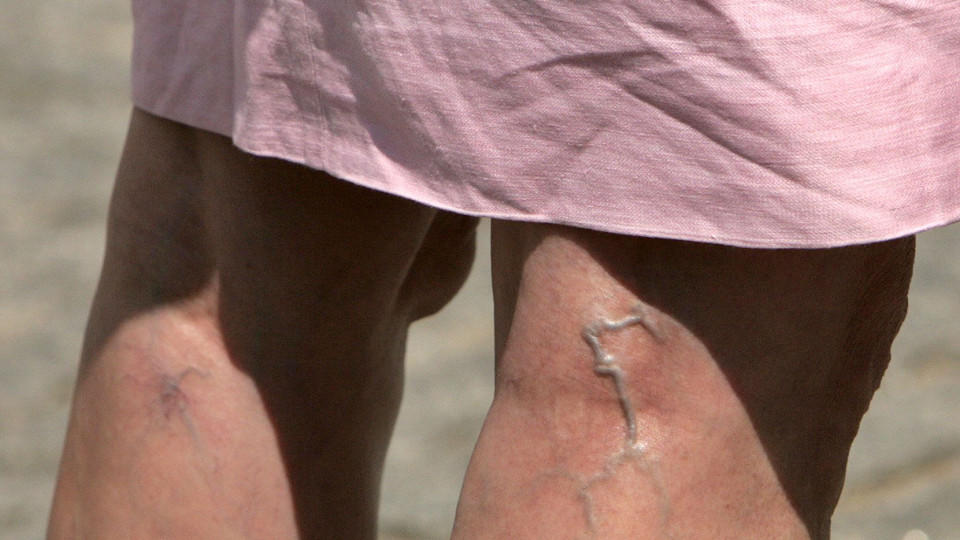 Der Blick auf die Beine einer Frau mit starken Krampfadern, aufgenommen 24.05.2007 in Berlin. Krampfadern (Varizen, Varikose) haben nichts mit "Krampf" zu tun. Der Begriff leitet sich von "Krummader" ab.Bei manchen Patienten ziehen sich die "krummen Adern" als Knötchen und Stränge über die Beine. Das, was die Betroffenen nicht nur aus kosmetischer Sicht stört, sondern auch ganz handfeste, nicht zu unterschätzende Beschwerden bereitet, sind erweiterte Venen. Normalerweise transportieren die Beinvenen das Blut zum Herzen. Sie umgehen dabei die Gesetze der Schwerkraft ± Venenklappen sorgen dafür, dass das Blut nicht immer wieder nach unten sackt. Muskelbewegungen üben auf die Venenwände Druck aus und sorgen so für den Transport nach oben. Schließen die Venenklappen jedoch nicht mehr richtig, kommt es zu einem Rückstau des Blutes und die Venen erweitern sich und treten dann ± vor allem an den Beinen ± dick hervor. Foto: Arno Burgi  +++(c) dpa - Report+++