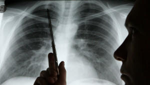 ARCHIV - Die Diagnose Lungenkrebs musste Nicolas Dickgreber dem 1968 geborenen Patienten mit diesem Röntgenbild geben, auf das er in der Medizinischen Hochschule Hannover (MHH) zeigt (Foto vom 15.11.2006). In Deutschland wird nach einer Schätzung des Robert-Koch-Instituts (RKI) im Jahr 2010 fast jede Minute eine neue Krebsdiagnose gestellt, wird am Dienstag (23.02.2010) in Berlin mitgeteilt. Foto: Rainer Jensen dpa/lbn (zu lbn 4077 vom 23.02.2010)  +++(c) dpa - Bildfunk+++
