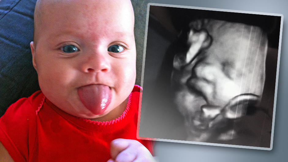 Beckwith-Wiedemann-Syndrom: Baby kam mit übergroßer Zunge zur Welt