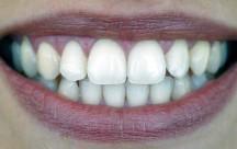 Bleaching macht die Zähne weiß - diese Methoden gibt es.