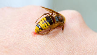 Hornet on a hand sting in the skin
