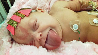 PICS BY MADISON KIENOW / CATERS NEWS - (PICTURED: Here you can see Paisleys massive tongue, at six months she would have the first of two reduction surgeries to ensure she didnt choke to death) - A baby born with a massive adult-sized tongue has finally been able to smile for the first time after life-changing surgery. Paisley, from Aberdeen in South Dakota, USA, had such a large tongue that she needed breathing apparatus for the first week of her life to stop her from choking to death. She was born with Beckwith Wiedemann Syndrome (BWS)  an overgrowth disorder that affects one in every 11,000 births worldwide. The rare condition caused the little girls tongue to grow more than twice the size of her mouth and it even shocked doctors, who said it was one of the largest tongues they had ever seen. Until she was six months old, Paisley had to be fed via by a gastronomy-tube because she struggled to eat and wasnt receiving the vital nutrients needed to keep her alive. - SEE CATERS COPY