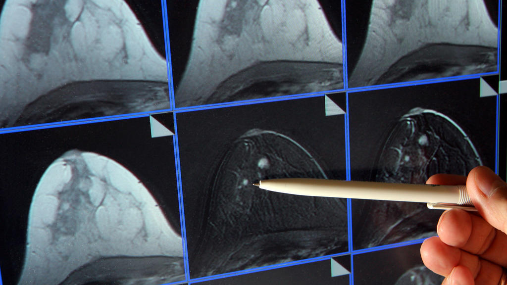 ARCHIV - Auf der Bildschirmdarstellung einer Magnetresonanz-(MR)-Mammographie ist am 04.07.2007 ein winziger Tumor in der Brust einer Patientin zu sehen. (zu dpa "Krebsbericht: Deutlich mehr Neuerkrankungen - aber auch Positives" vom 29.11.2016) +++(