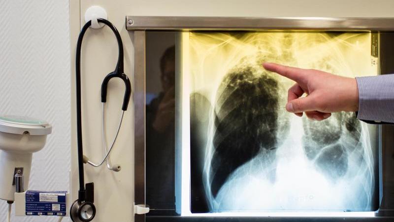 Ein Tuberkulose-Fall auf einem Röntgenbild im Tuberkulose-Zentrum Berlin-Lichtenberg.