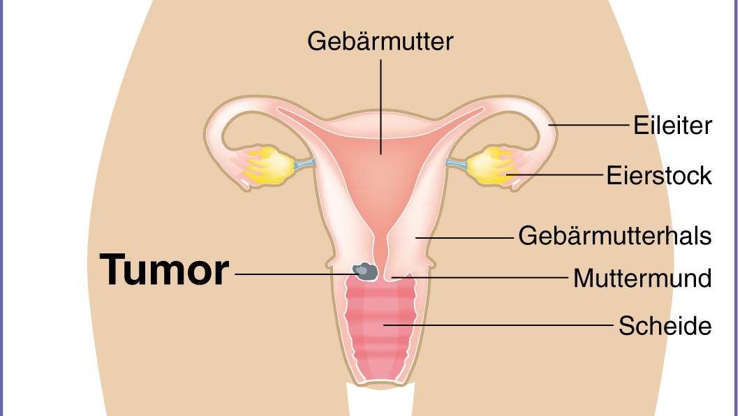 Zum Themendienst-Bericht "Früherkennung von Gebärmutterhalskrebs: Wann lohnt ein HPV-Test?" von Arnd Petry vom 26. März 2014: Humane Papillomviren können die Zellen in der Gebärmutterschleimhaut so verändern, dass im Gebärmutterhals ein Tumor entsteh