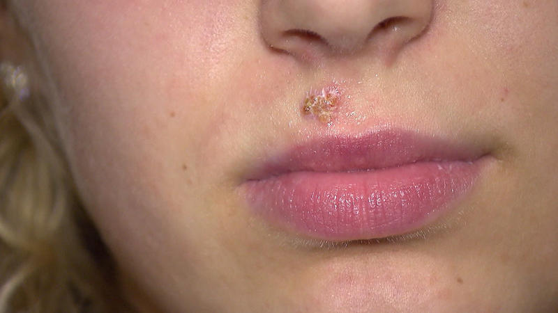 Herpes Diese Hausmittel helfen gegen die lästigen Lippenbläschen